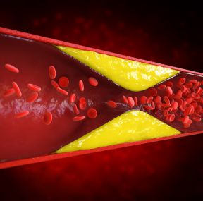 Endocrinologia em Panambi para Tratar Dislipidemia